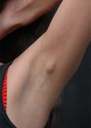 Illustration for article titled What's That Lump In Amy Winehouse's Armpit?